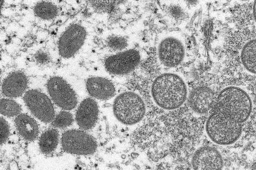 Vancouver Island confirms 1st monkeypox case