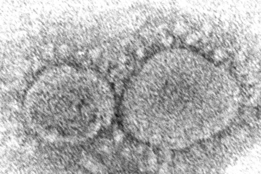 An electron microscope image of SARS-CoV-2 virus particles which cause COVID-19