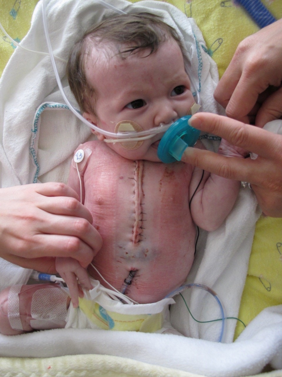 At less than one-month-old, Addison McArthur became the first baby to receive a heart transplant at BC Children's Hospital more than 12 years ago. 