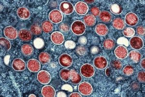 Vancouver’s health authority says cases of mpox virus on the rise