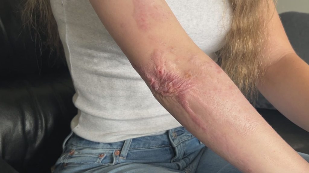 Pitt Meadows resident Alex Paterson suffered second and third degree burns last year. (CityNews Image)