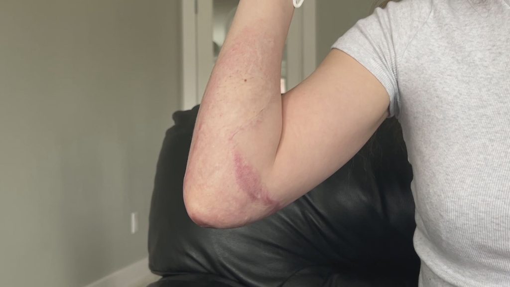 Pitt Meadows resident Alex Paterson suffered second and third degree burns last year. (CityNews Image)